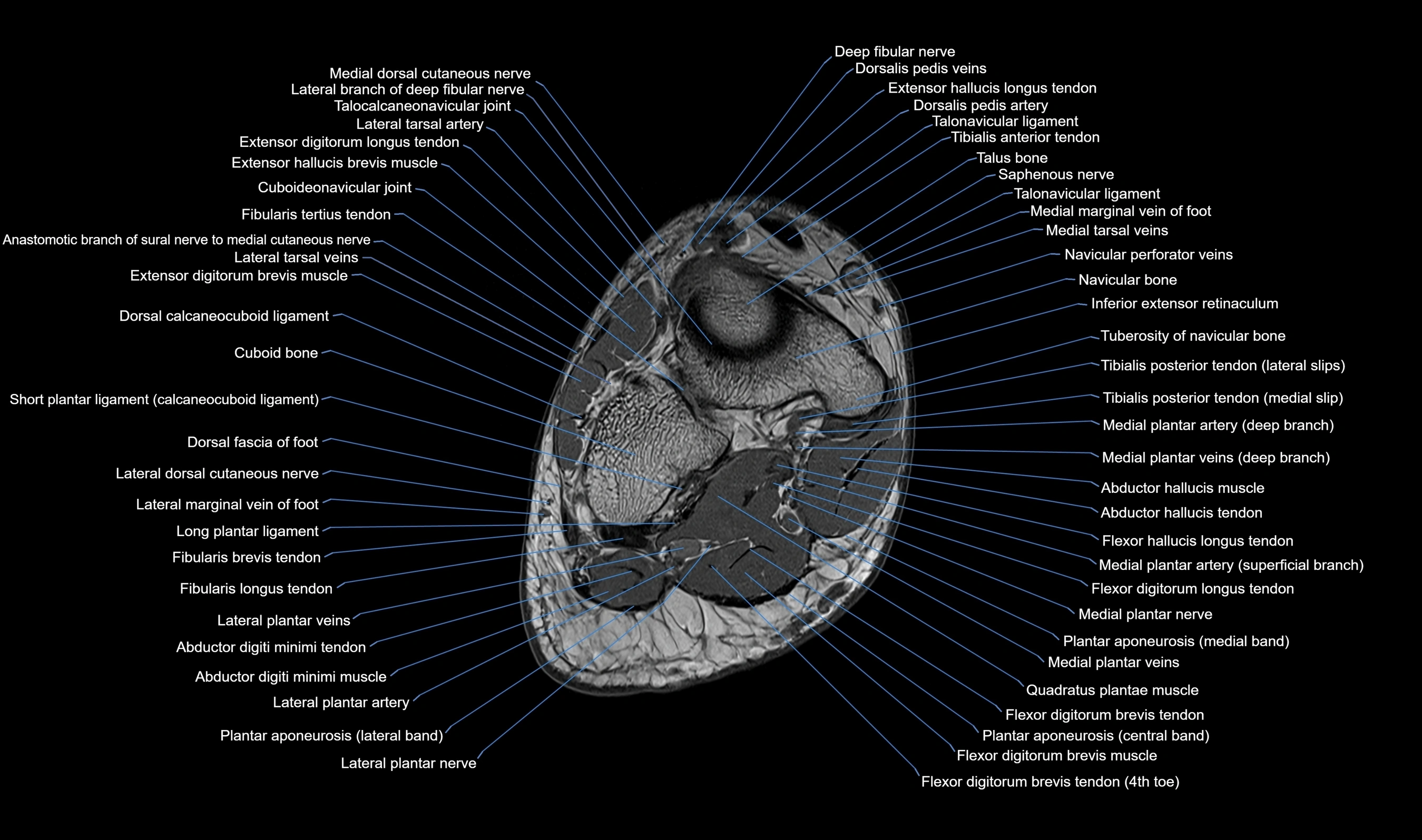 MRI mid foot axial cross sectional anatomy 3T  radiology  image-img-00001-00032.webp
